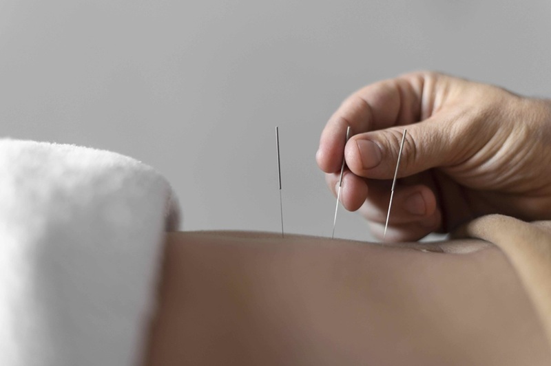 Acupuncture Treatment