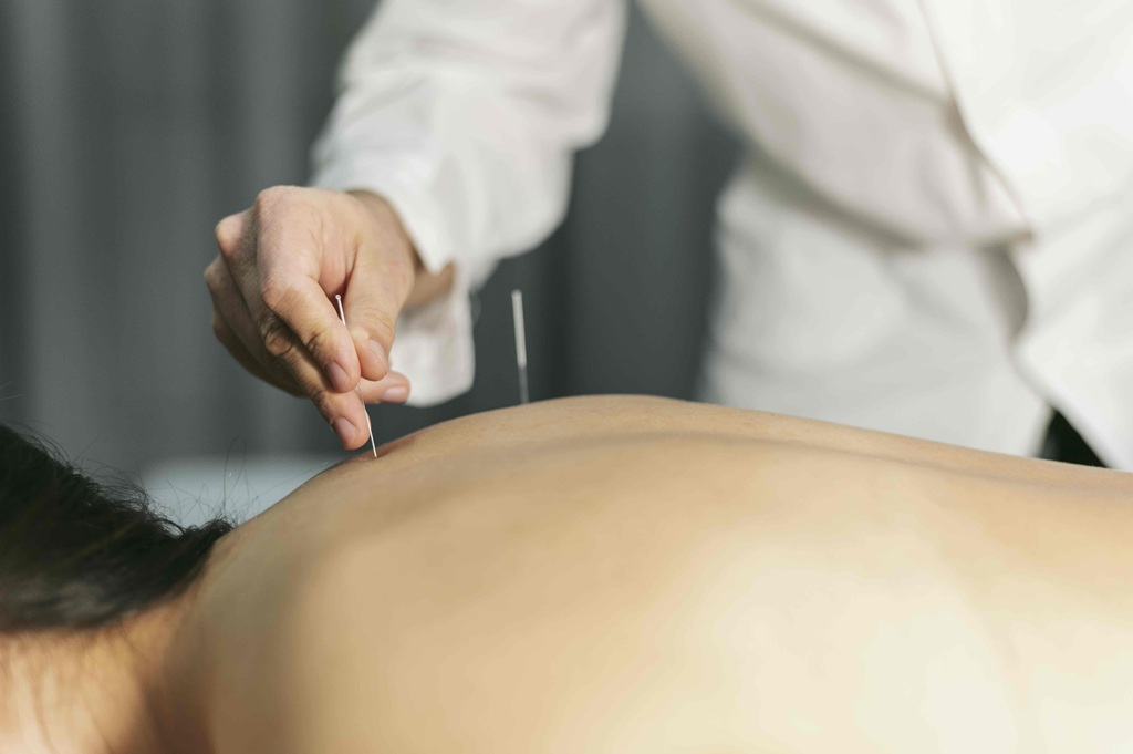 Acupuncture Treatment